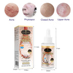 Aichun Beauty Moisturizing, Brightening and Anti Acne Rice Face Serum AC3122